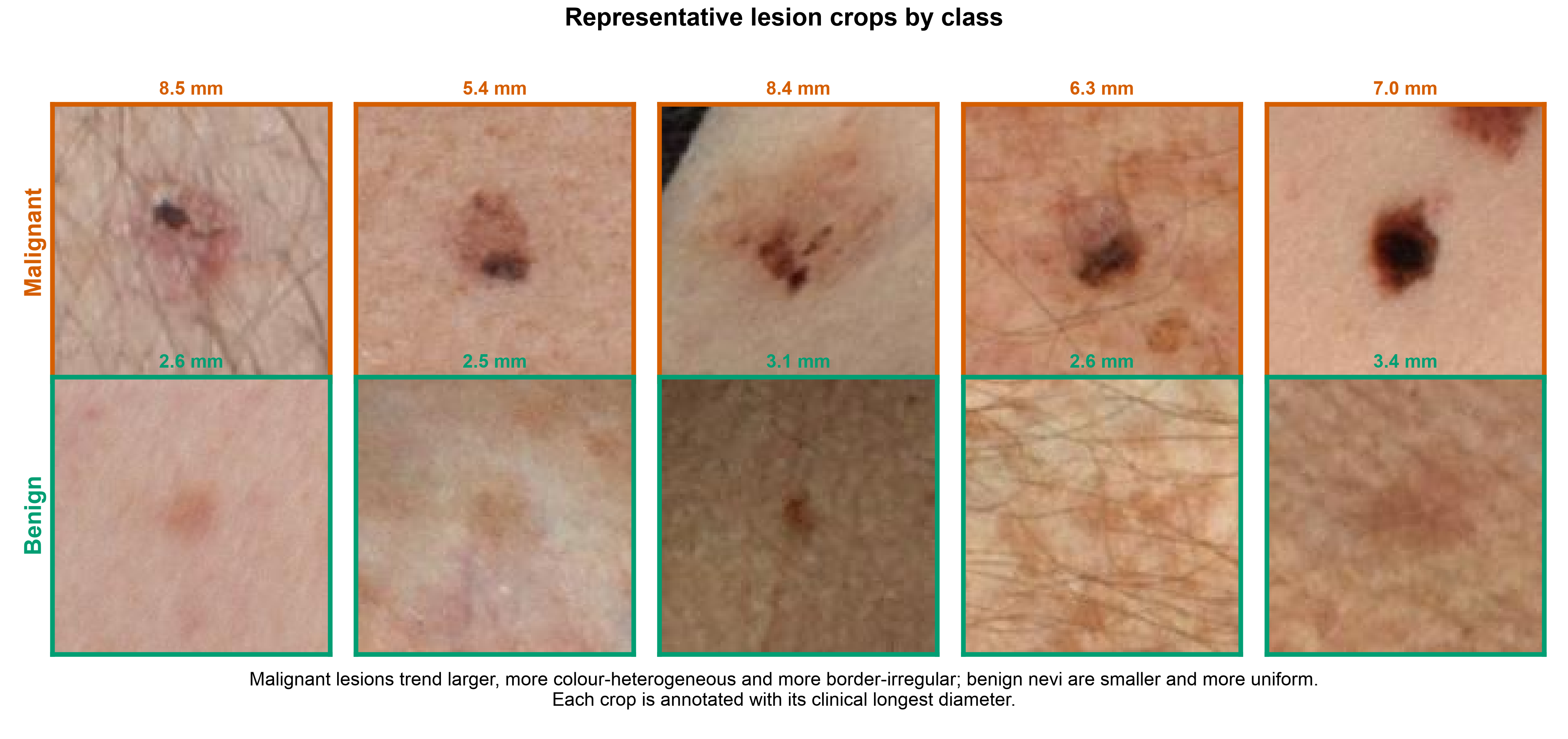 Representative benign and malignant lesion crops